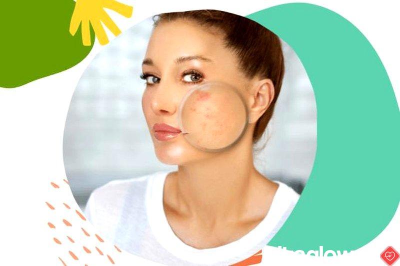 Produkty do pielęgnacji skóry dla mężczyzn z trądzikiem hormonalnym
