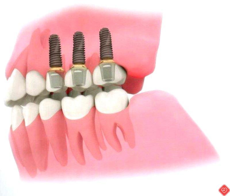 Trwałość implantów silikonowych w czasie